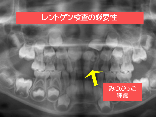 レントゲン検査の必要性