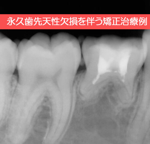 永久歯先天性欠損を伴う矯正治療例