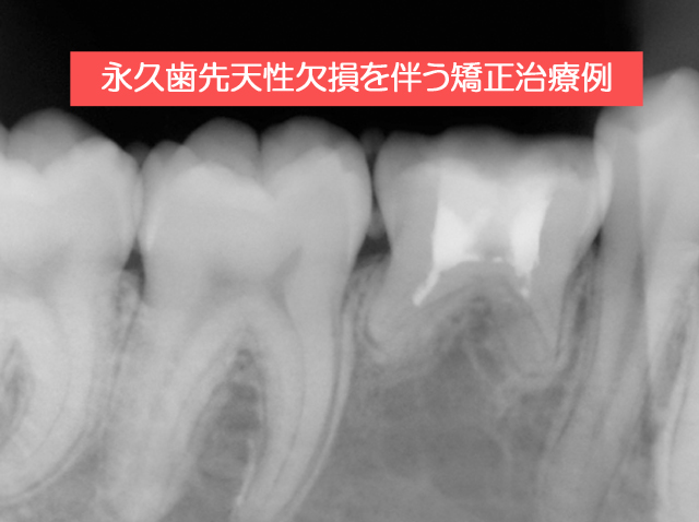 永久歯先天性欠損を伴う矯正治療例