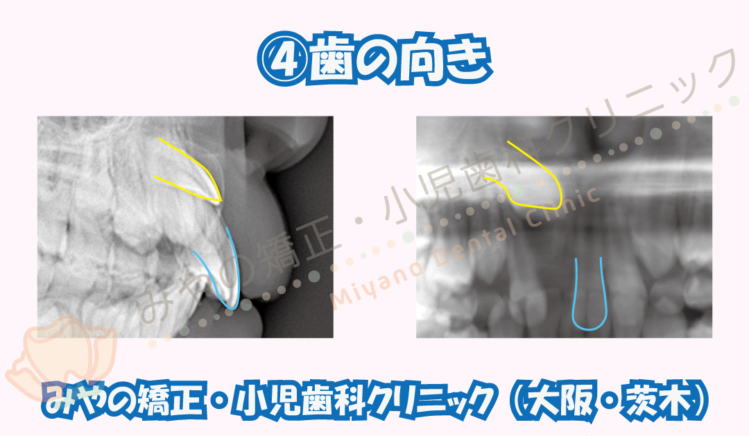 ④歯の向き