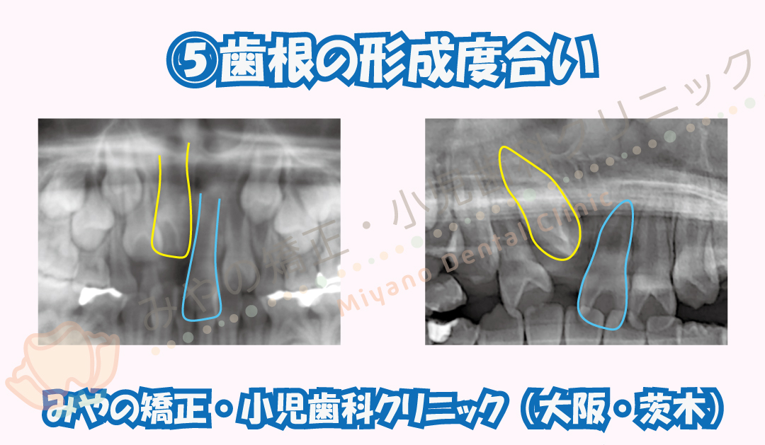⑤歯根の形成度合い