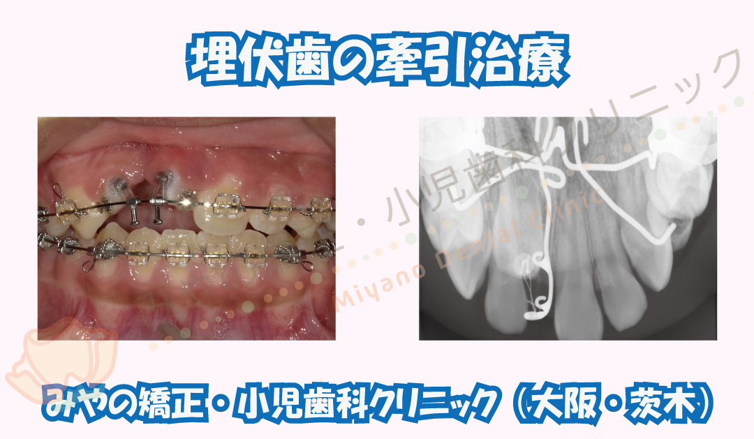 埋伏歯の牽引治療