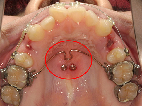 ①歯科矯正用アンカースクリュー