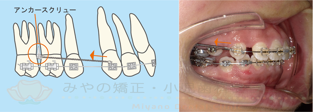 アンカースクリュー