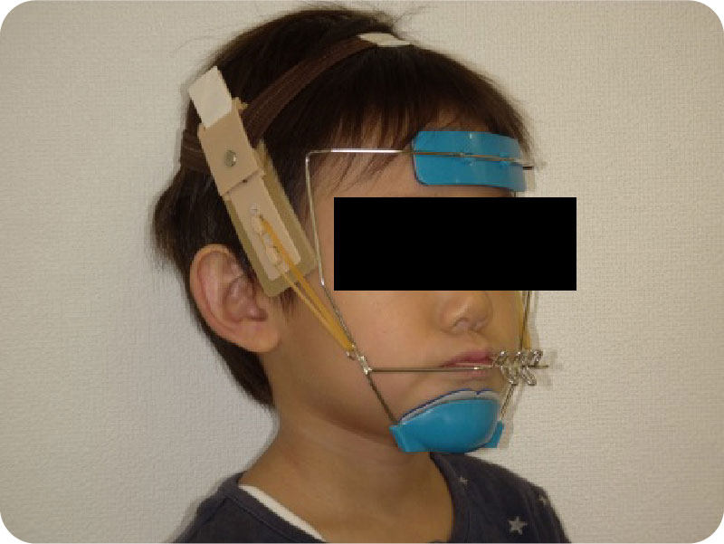 フェイスマスク上顎骨前方牽引装置