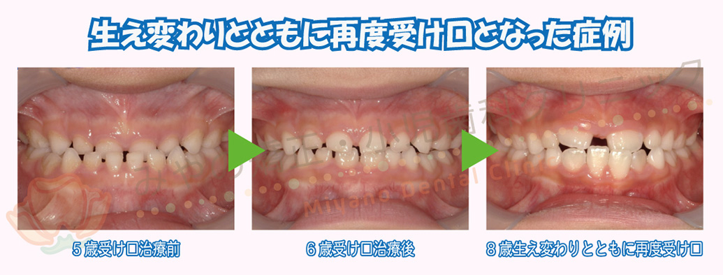 生え変わりとともに再度受け口となった症例