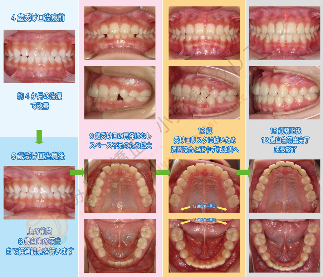 矯正治療例A:4歳で受け口治療を行い、成長を経過観察しながら矯正治療を行った例(女の子)