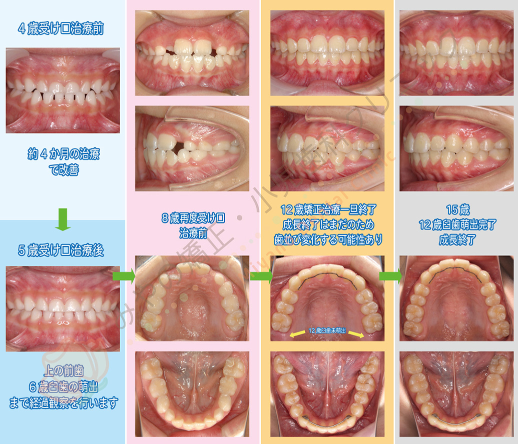 矯正治療例B:4歳で受け口治療を行い矯正治療後、成長の経過観察を行った例(女の子)