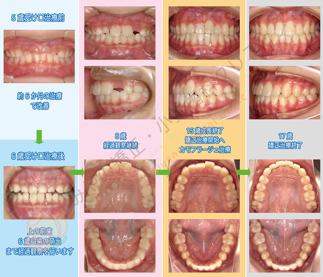 矯正治療例C:5歳で受け口治療を行い、成長終了まで待機後続きの矯正治療を行った例(女の子)