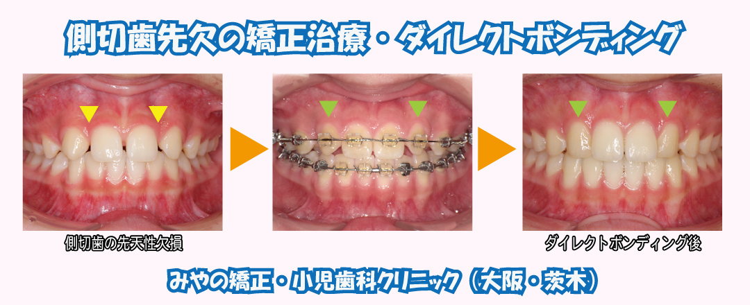 矯正治療の中でダイレクトボンディングを行うケース2