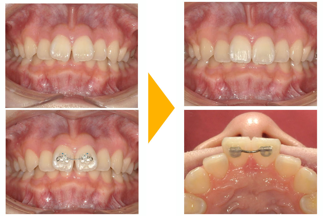 すきっぱ(正中離開)の部分矯正治療