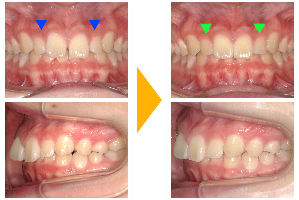 すきっぱ(正中離開)の部分矯正治療