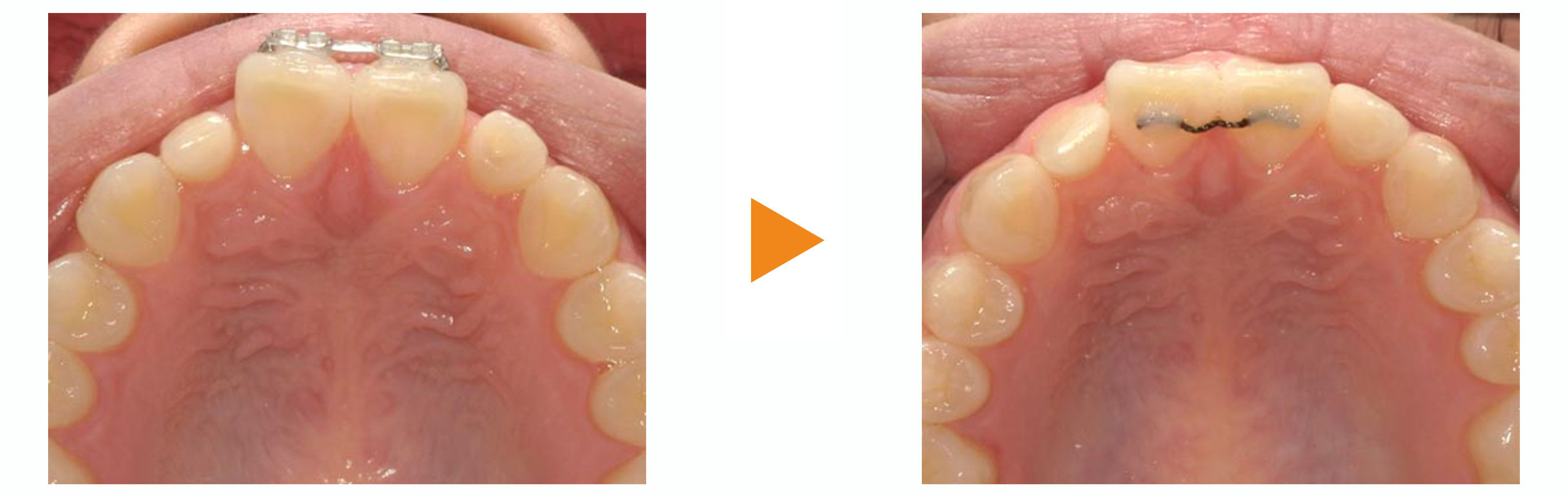 すきっぱ(正中離開)の部分矯正治療