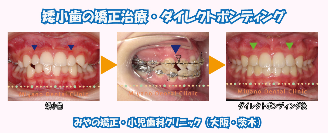 矯正治療の中でダイレクトボンディングを行うケース1