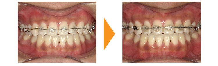歯のガタガタ改善(再治療・マウスピース矯正→ワイヤー矯正)