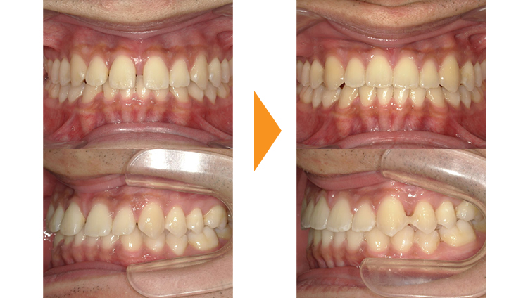 すきっぱ(正中離開)の矯正治療