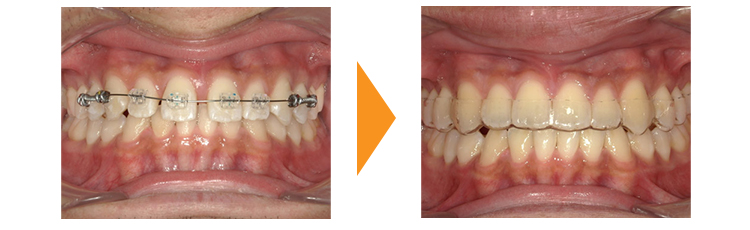 歯のガタガタ改善(再治療・マウスピース矯正→ワイヤー矯正)