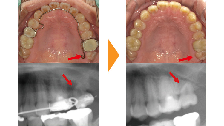歯のガタガタ改善(再治療・マウスピース矯正→ワイヤー矯正)