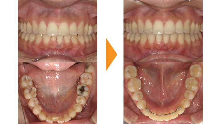 すきっぱ(正中離開)の矯正治療