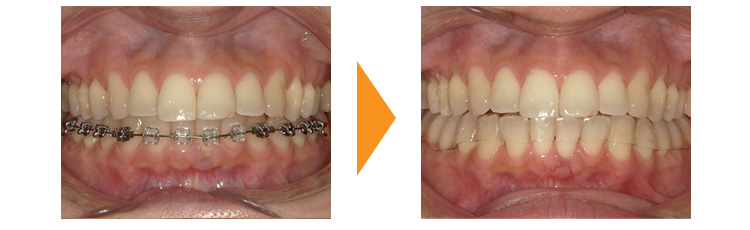 歯のガタガタ改善(再治療・マウスピース矯正→ワイヤー矯正)