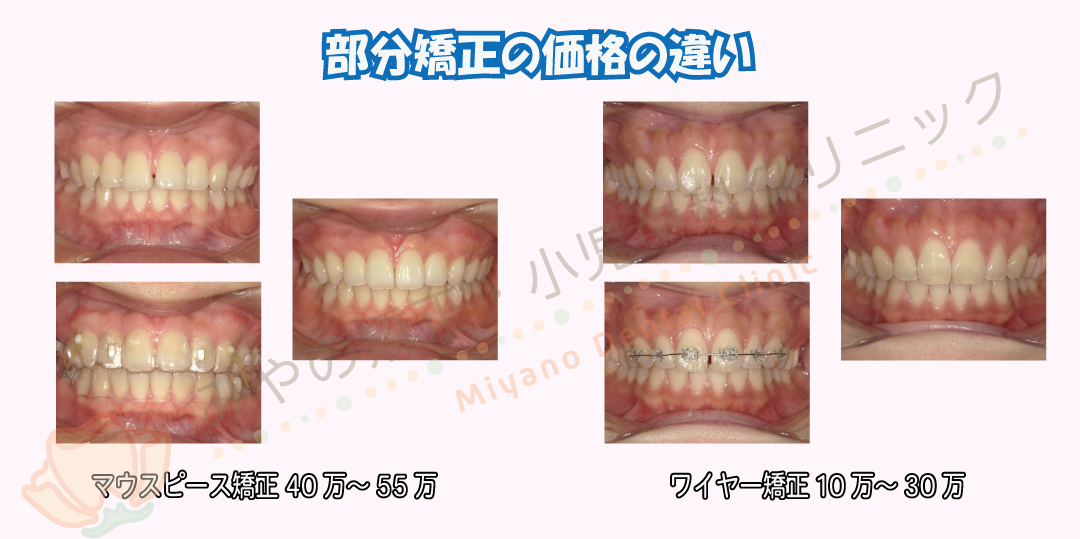 部分矯正の価格の違い