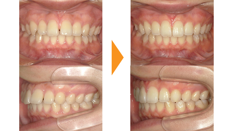 すきっぱ(正中離開)・出っ歯(上顎前)の矯正治療