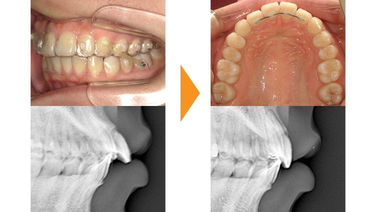 すきっぱ(正中離開)・出っ歯(上顎前)の矯正治療