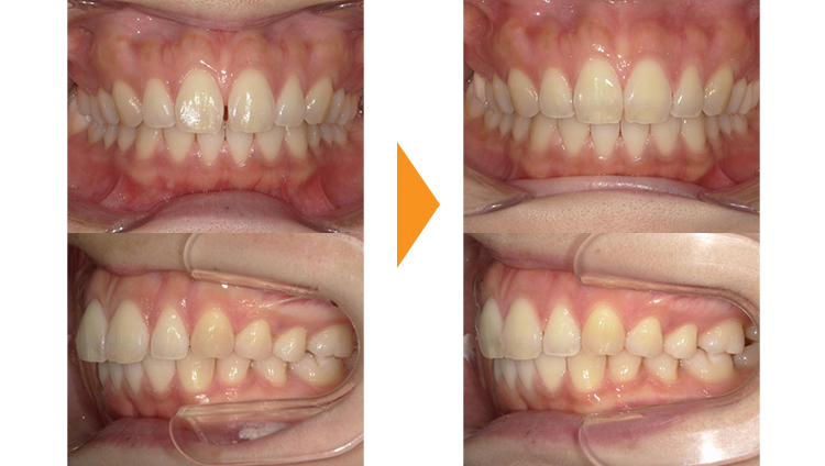すきっぱ(正中離開)の矯正治療