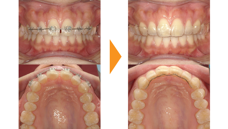 すきっぱ(正中離開)・出っ歯(上顎前)の矯正治療