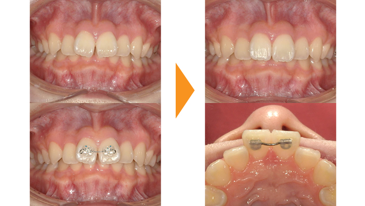 すきっぱ(正中離開)の矯正治療