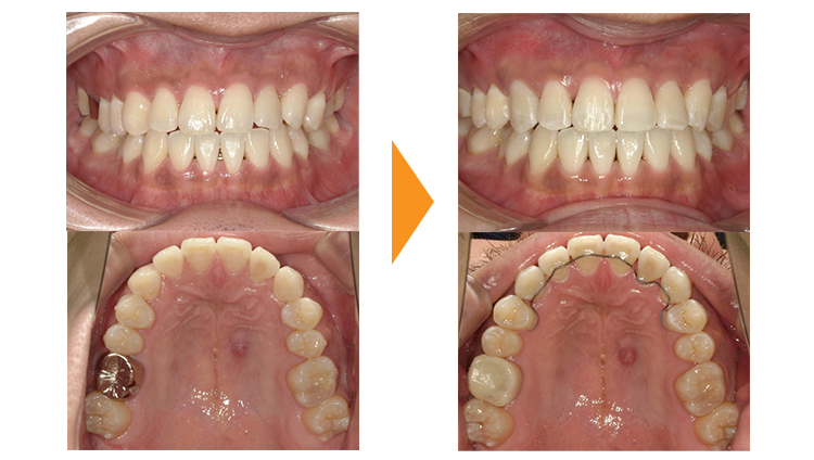 歯のガタガタ改善(再治療・マウスピース矯正→ワイヤー矯正)
