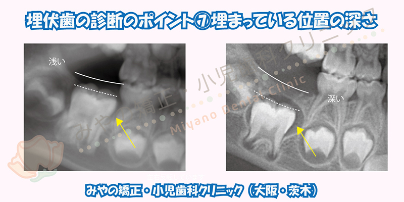 埋伏歯の診断のポイント ⑦埋まっている位置の深さ