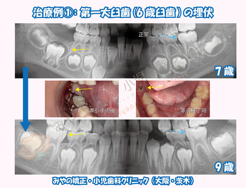 治療例①:第一大臼歯(6歳臼歯)の埋伏