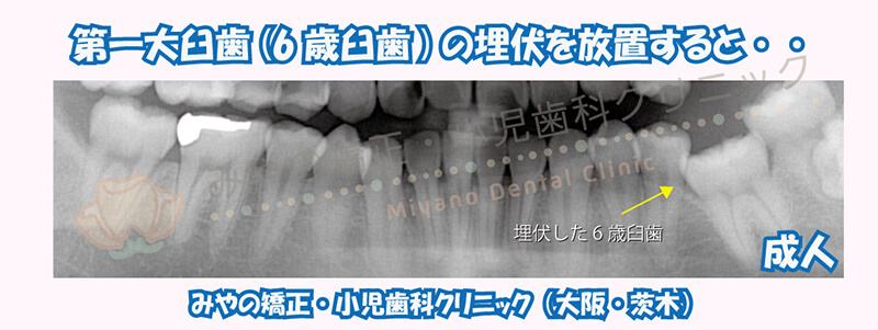 第一大臼歯(6歳臼歯)の埋伏を放置すると