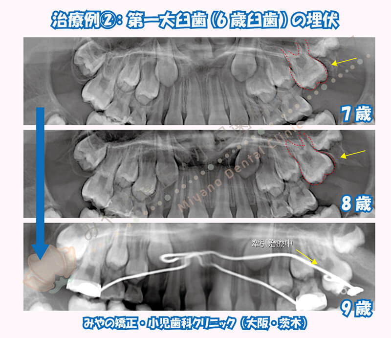 治療例②:第一大臼歯(6歳臼歯)の埋伏