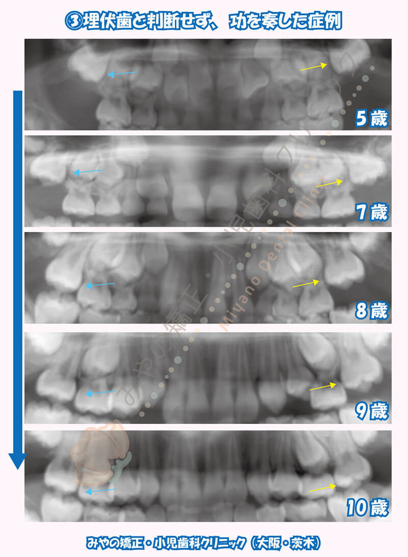 ③埋伏歯と判断せず、功を奏した症例(矯正治療はしていない)