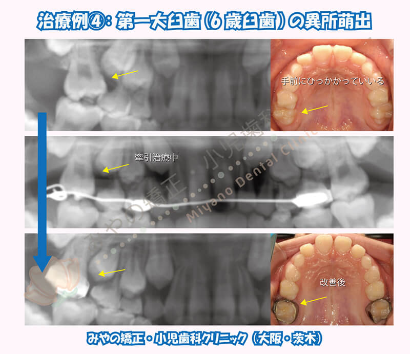 治療例④:第一大臼歯(6歳臼歯)の異所萌出