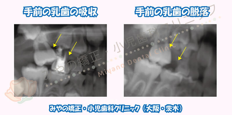 治療例④:第一大臼歯(6歳臼歯)の異所萌出