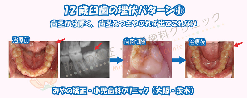 12歳臼歯の埋伏①歯茎が分厚く、歯茎をつきやぶれず出てこれない