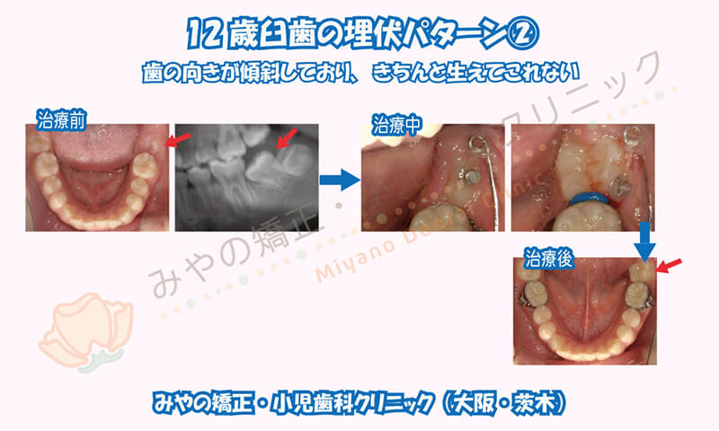 12歳臼歯の埋伏②歯の向きが傾斜しており、きちんと生えてこれない