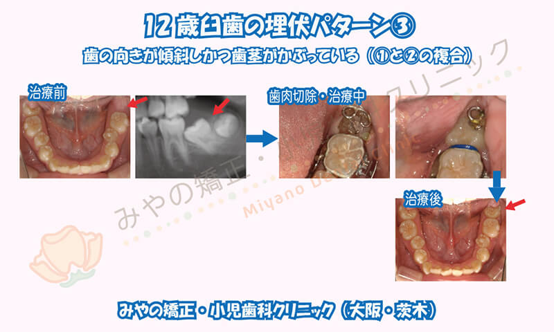 12歳臼歯の埋伏③歯の向きが傾斜し、かつ歯茎がかぶっている(①と②の複合)