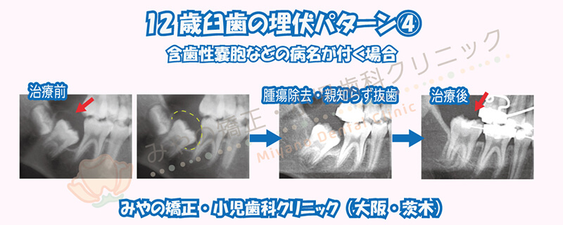 12歳臼歯の埋伏④含歯性嚢胞などの病名が付く場合