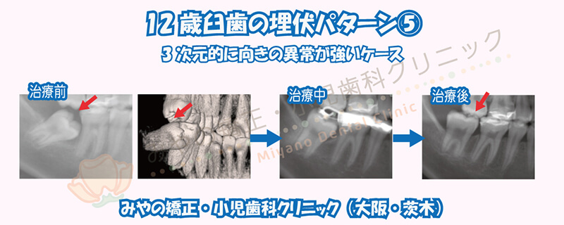 12歳臼歯の埋伏⑤3次元的に向きの異常が強いケース