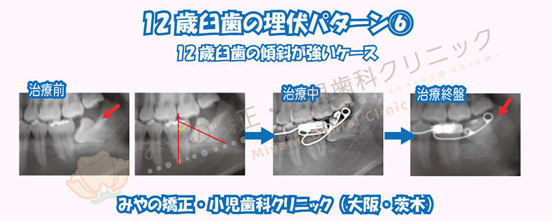12歳臼歯の埋伏⑥12歳臼歯の傾斜が強いケース