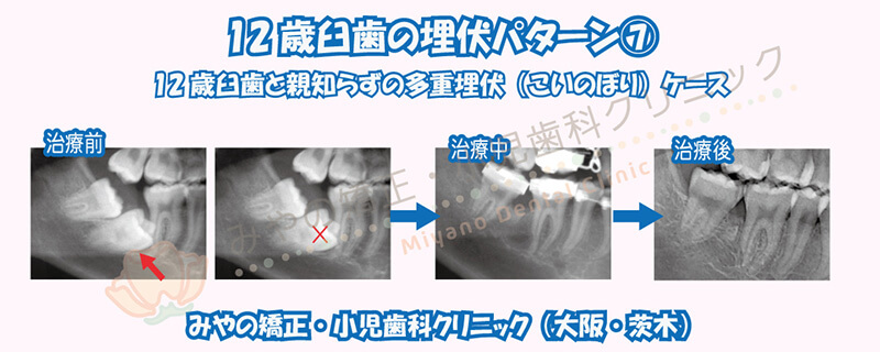 12歳臼歯の埋伏⑦12歳臼歯と親知らずの多重埋伏(こいのぼり)ケース