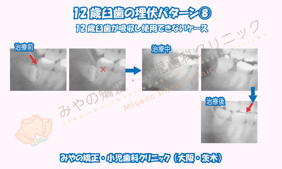 12歳臼歯の埋伏⑧12歳臼歯が吸収し使用できないケース