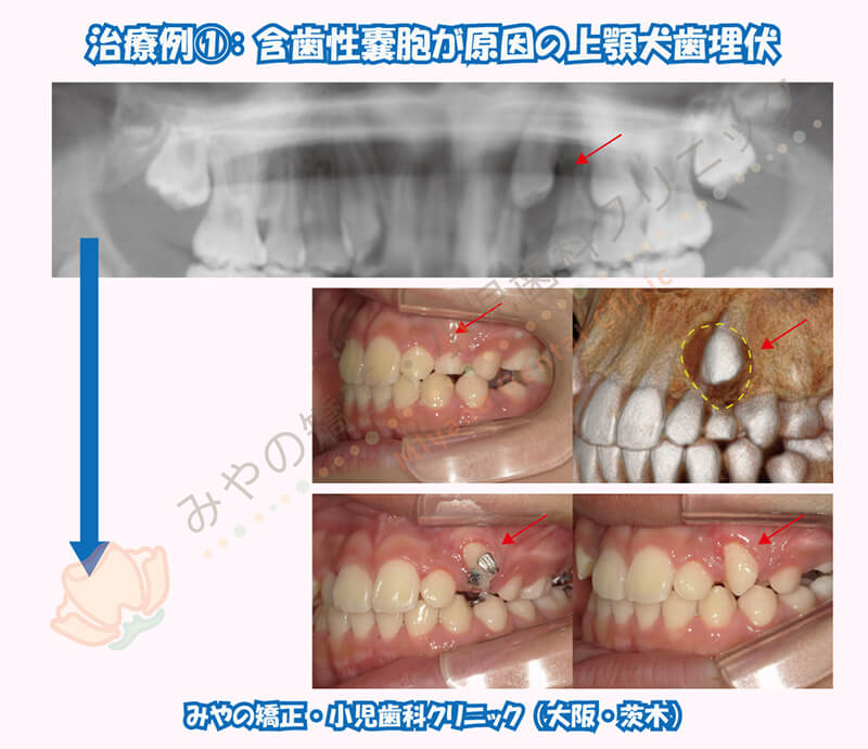 犬歯埋伏治療例①:含歯性嚢胞が原因の上顎犬歯埋伏