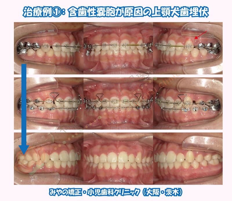 犬歯埋伏治療例①:含歯性嚢胞が原因の上顎犬歯埋伏