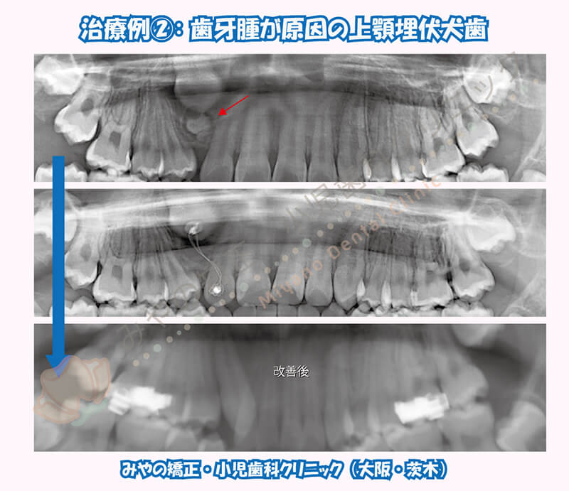 犬歯埋伏治療例②:歯牙腫が原因の上顎埋伏犬歯