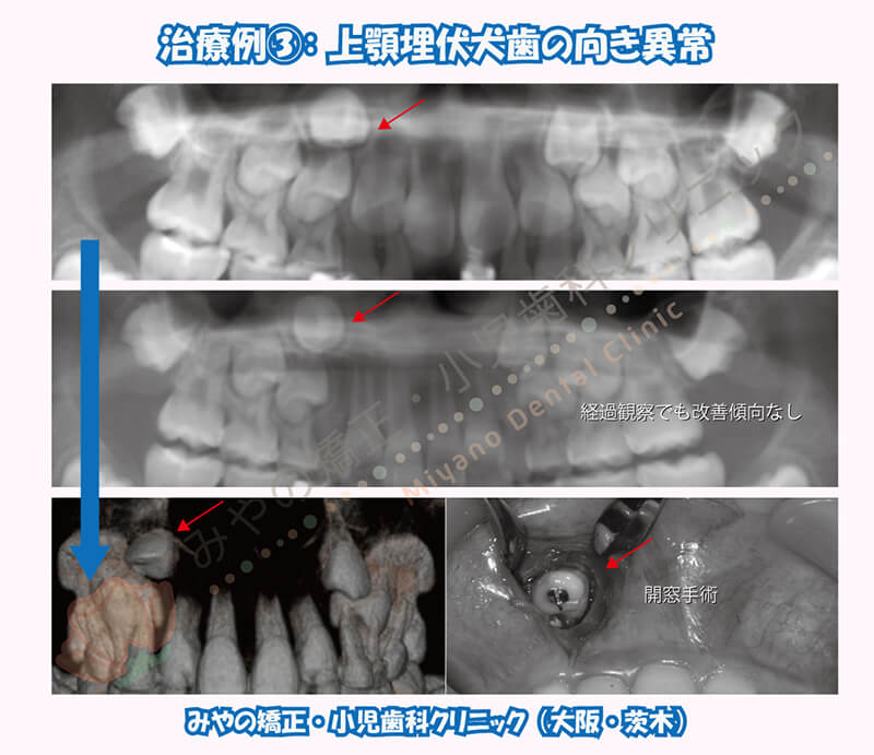 犬歯埋伏治療例③:上顎埋伏犬歯の向き異常